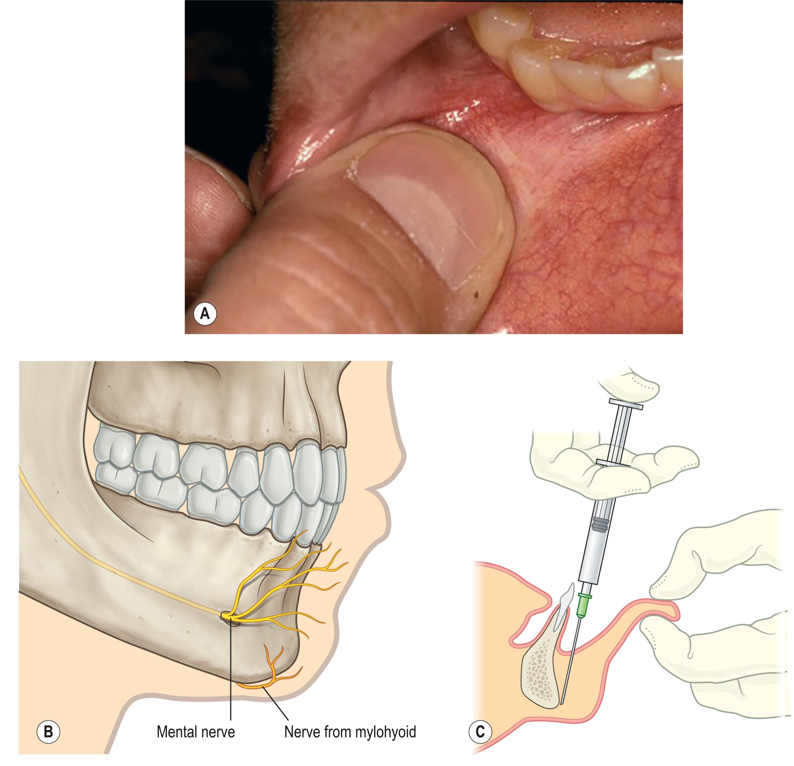 Figure 5.4, The pertinent anatomy and mental nerve and mental nerve plus block (nerve to the mylohyoid). (A) The generally palpable and sometimes visible mental nerve. (B) Mental nerve exiting the foramen and the nerve to the mylohyoid entering from the neck to innervate a portion of the chin pad. (C) The preferred method for the mental and mental plus nerve blocks.