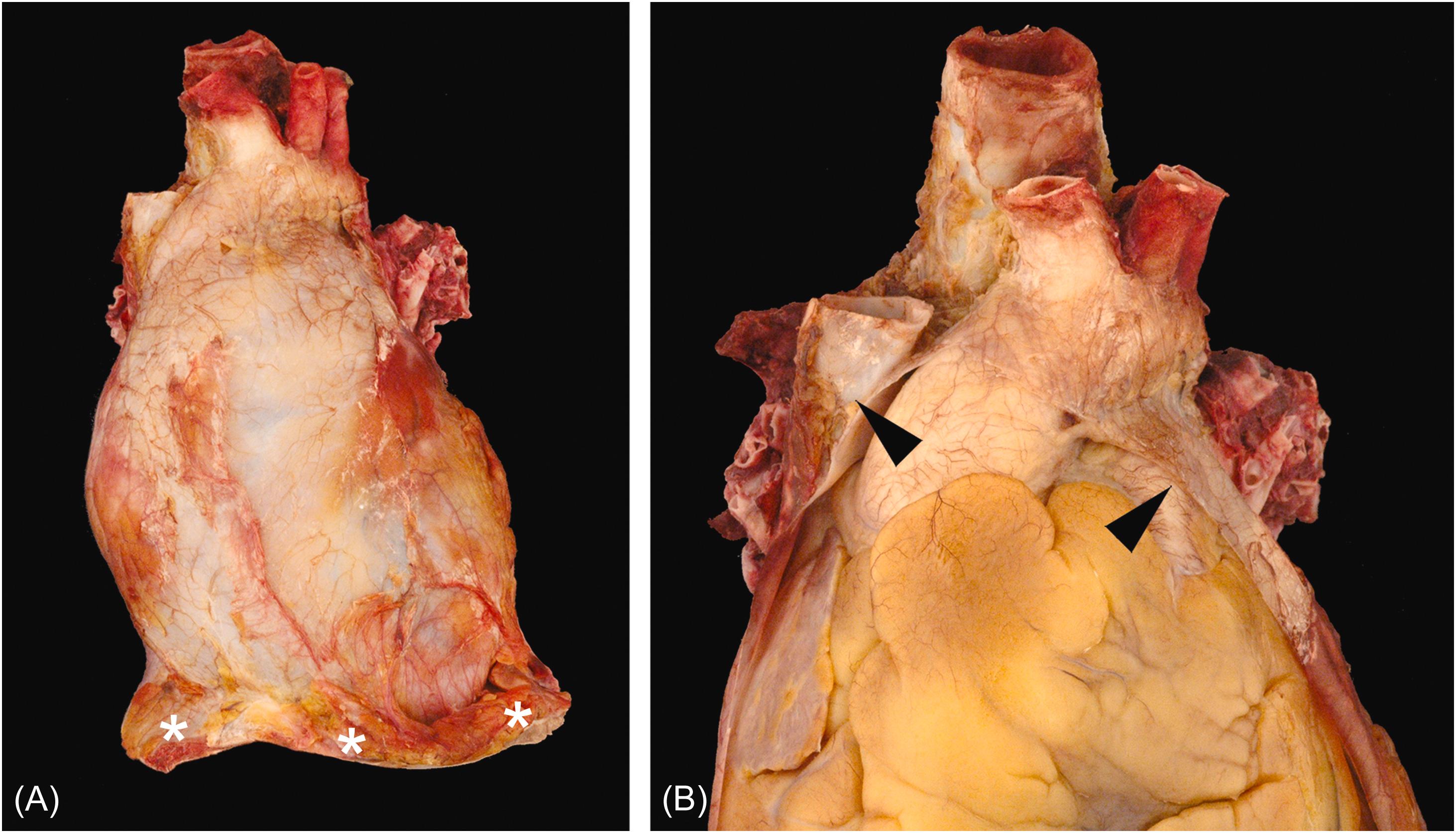 Figure 2.1, Pericardium. (A) The parietal (fibrous) pericardium covers the heart and proximal great arteries. The diaphragm (asterisks) can be seen along the inferior border. (B) With the anterior parietal pericardium removed (arrowheads), the relationship with the heart (invested with visceral pericardium) can be appreciated.