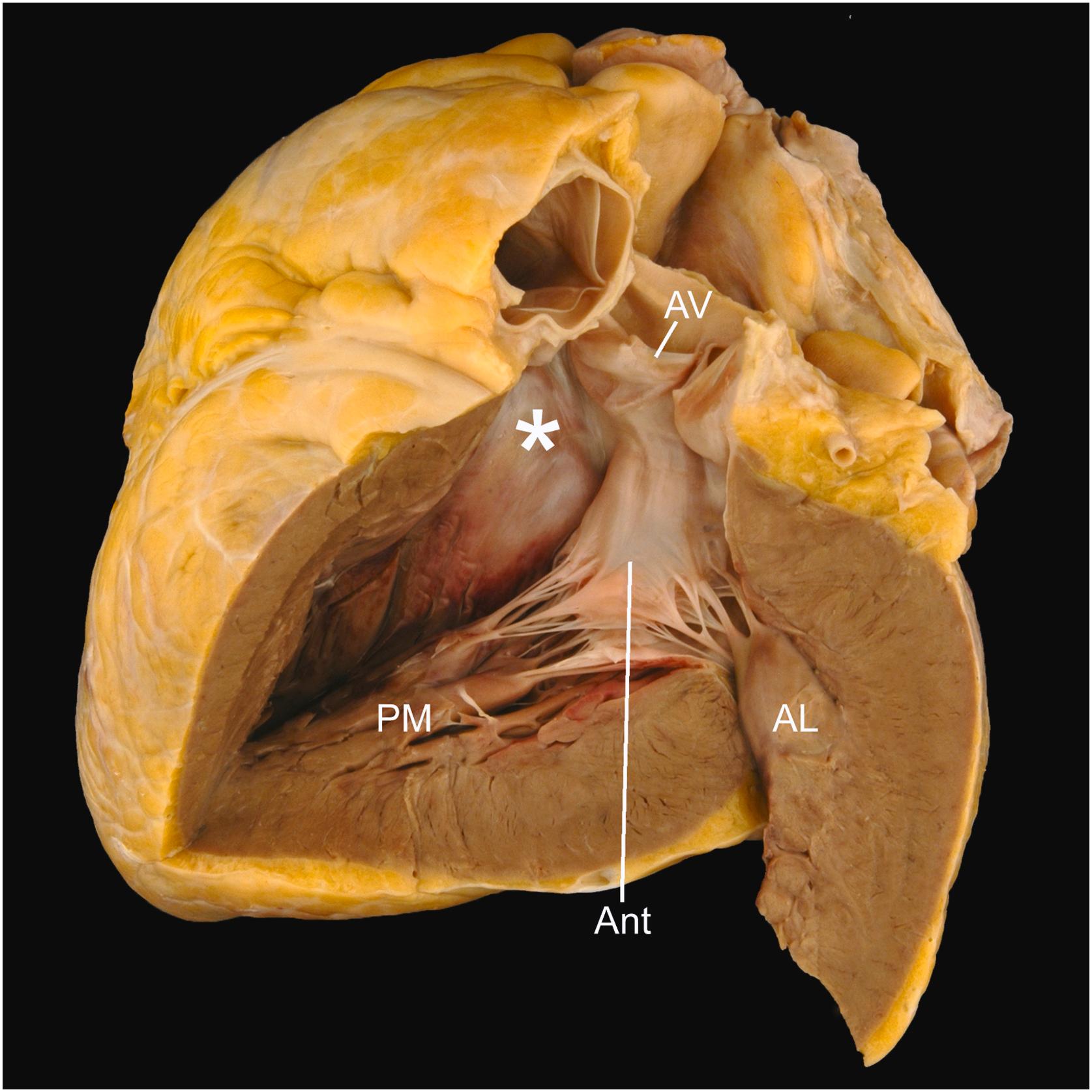 Figure 2.12, Left ventricular outflow tract. Opened along the outflow tract, the various morphologic features that allow discrimination from the right ventricle can be identified. The anterior mitral valve leaflet (Ant) is in fibrous continuity with the aortic valve (AV) and with the ventricular septum forms a musculomembranous outflow tract (asterisk). The posteromedial (PM) and anterolateral (AL) papillary muscles can also be identified.