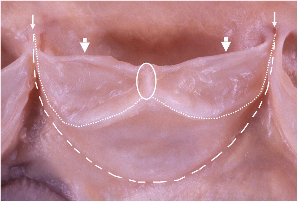 Figure 2.13, Aortic valve cusp. The semilunar valve commissures (small arrows) are the points that adjacent cusps meet along the annulus (large dashed line). The free edge (large arrows) represents the distal-most portion of the cusp and the thickened biscalloped ridge (small dotted line) is the line of closure where adjacent cusps come into coaptation. The closing edge meets at a central nodular thickening, the nodule of Arantius (circle).