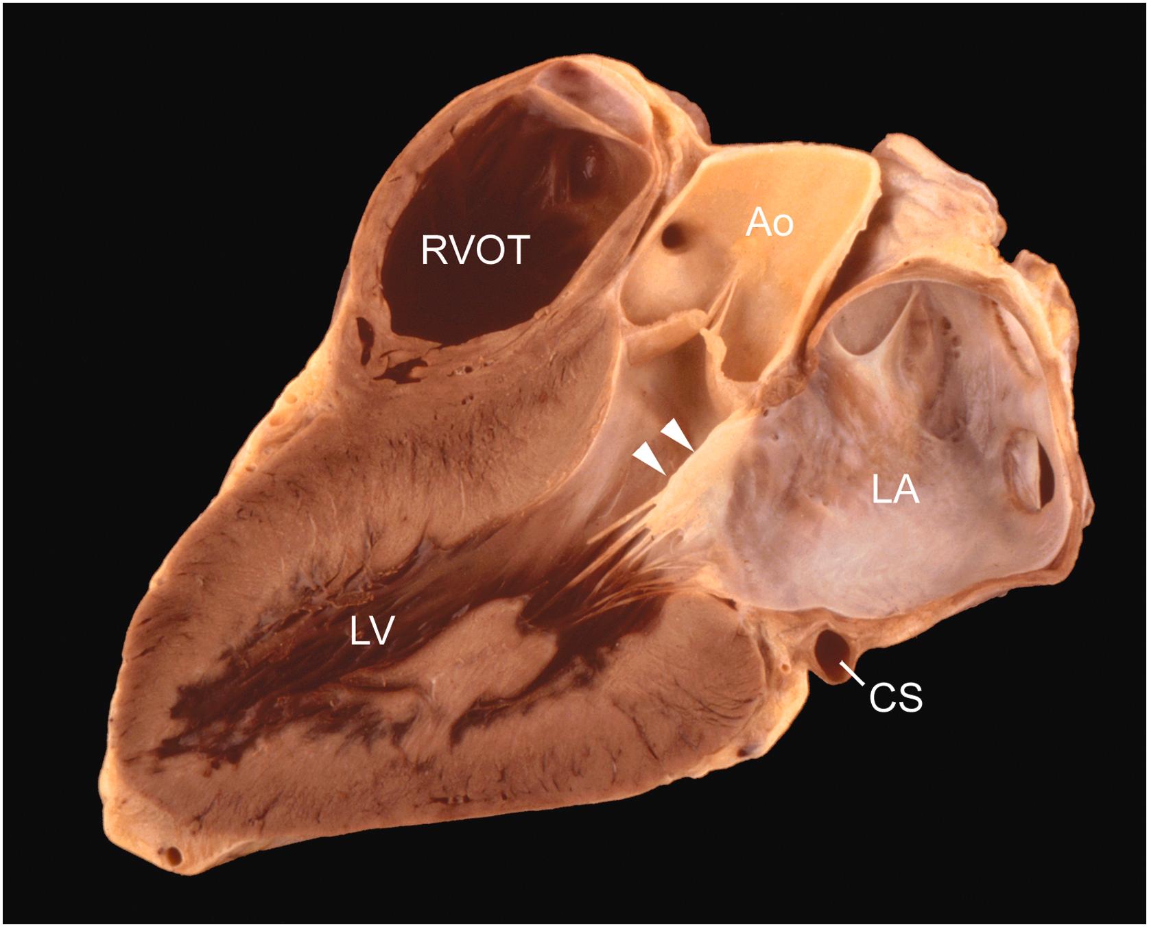 Figure 2.15, Left ventricular long-axis view of the heart (3-chamber view). The plane that bisects the mitral and aortic valve reveals the contribution of the anterior mitral valve leaflet to the left ventricular outflow tract (arrowheads). The planes passage through right ventricular outflow tract (RVOT) allows three chambers to be visualized that include the left atrium (LA) and left ventricle (LV). CS , coronary sinus; Ao , aorta.