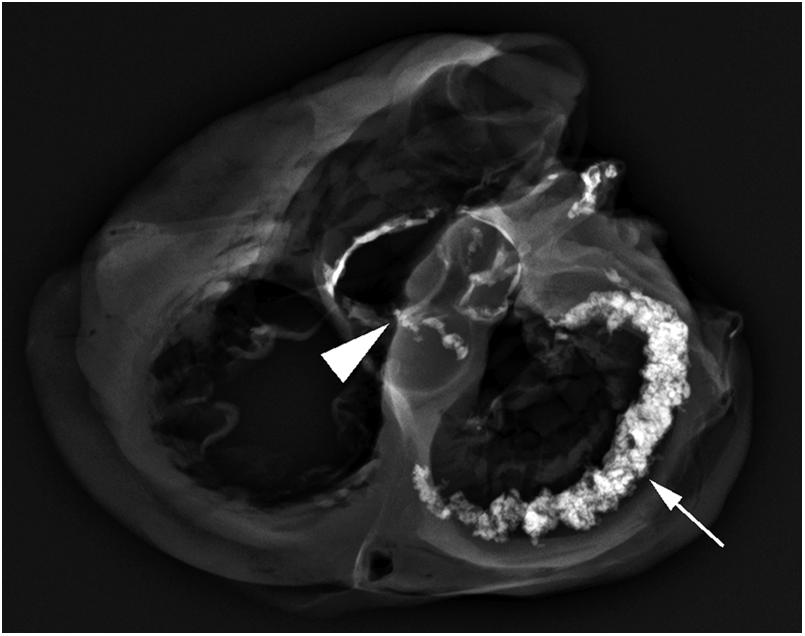 Figure 2.16, Radiographic evaluation of an autopsy specimen. Radiography can help to identify and quantify the amount of calcification in the cardiac specimen. In this case, prominent annular calcification (arrow) can be seen along the posterior mitral valve as well as calcification of the aortic valve cusps (arrowhead).