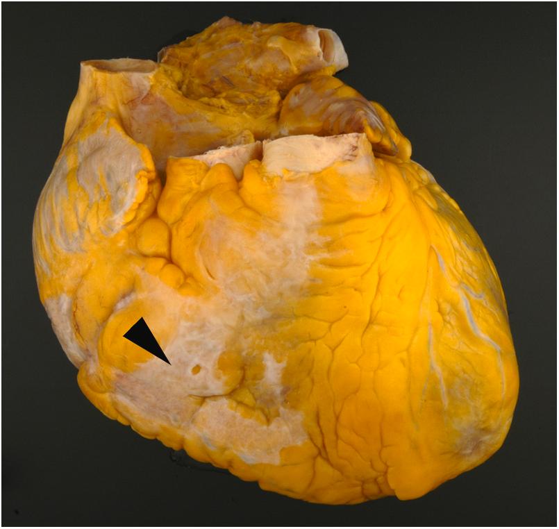 Figure 2.2, Epicardial collagen plaque (soldier’s patch). These focal tan-white fibrous patches (arrowhead) are most often located on the anterior aspect of the heart.