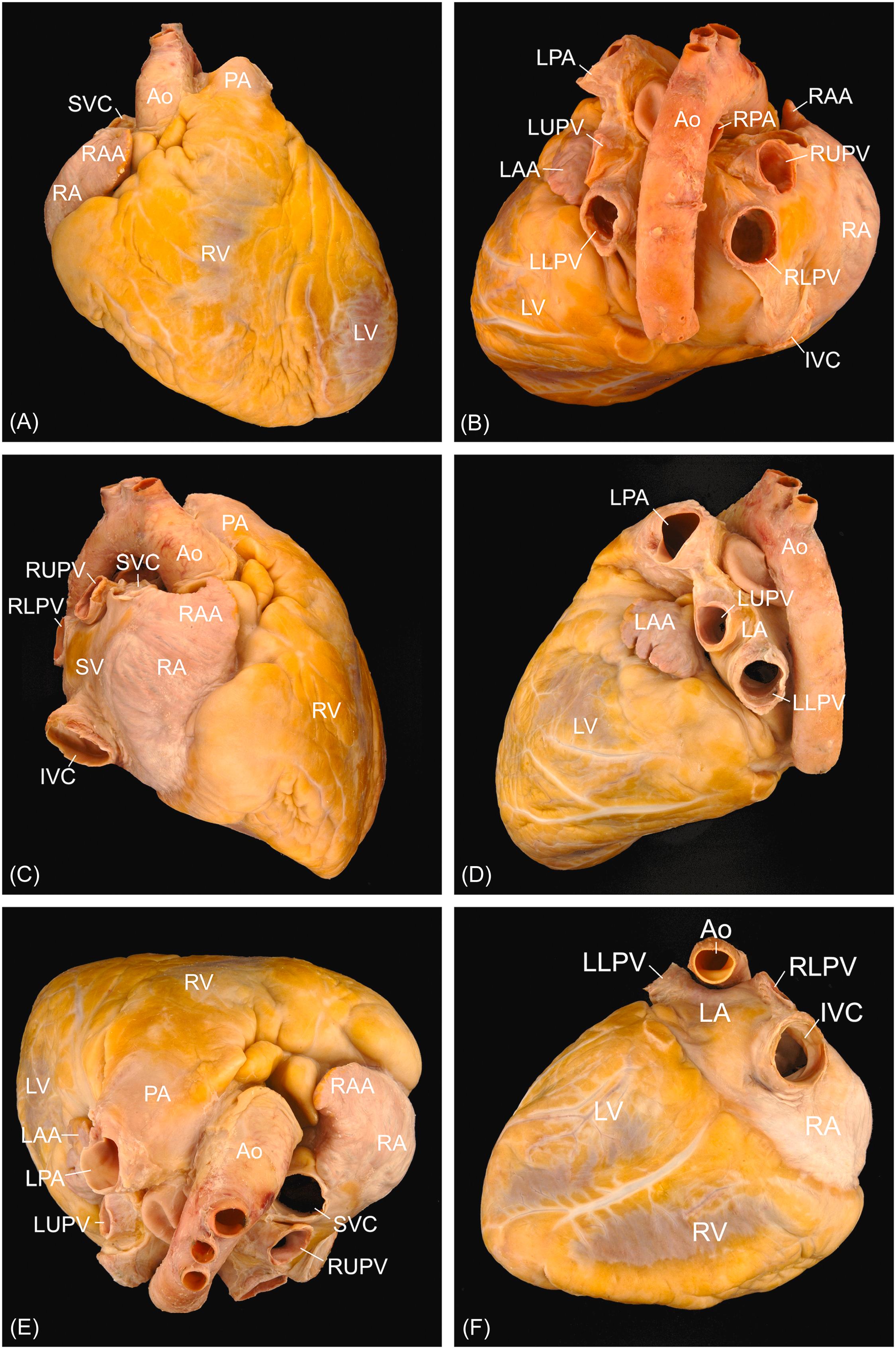 Figure 2.3, External cardiac anatomy. (A) Anterior perspective. (B) Posterior perspective. (C) Right lateral perspective. (D) Left lateral perspective. (E) Superior perspective. (F) Inferior perspective. Ao , aorta; IVC , inferior vena cava; LA , left atrium; LAA , left atrial appendage; LPA , left pulmonary artery; LLPV , left lower pulmonary vein; LUPV , left upper pulmonary vein; LV , left ventricle; RA , right atrium; RAA , right atrial appendage; RLPV , right lower pulmonary vein; RUPV , right upper pulmonary vein; RV , right ventricle; PA , pulmonary artery; SV , sinus venosus; SVC , superior vena cava.