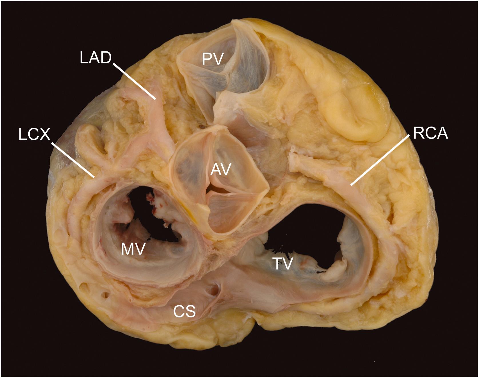 Figure 2.4, Base of the heart. The cardiac base (with atria removed) demonstrates the relationship of the four major cardiac valves as well as the disposition of the epicardial coronary arteries and coronary sinus. AV , aortic valve; CS , coronary sinus; LAD , left anterior descending coronary artery; LCX , left circumflex coronary artery; MV , mitral valve; PV , pulmonary valve; RCA , right coronary artery; TV , tricuspid valve.