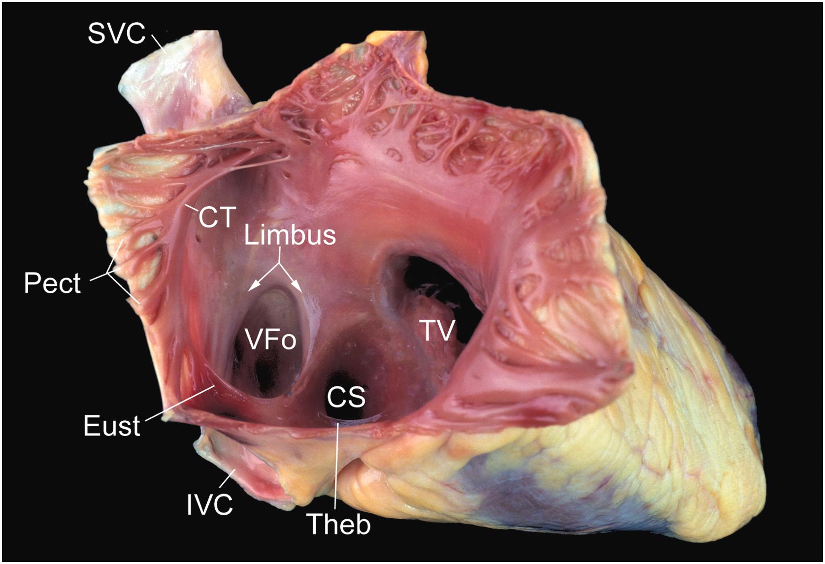 Figure 2.5, Internal anatomy of the right atrium. With the free wall opened, the anatomy of both the free wall and septum can be appreciated. CT , crista terminalis; CS , coronary sinus ostium; Eust , Eustachian valve; IVC , inferior vena cava; Pect , pectinate muscles; SVC , superior vena cava; Theb , Thebesian valve; TV , tricuspid valve; VFo , valve of the foramen ovale.