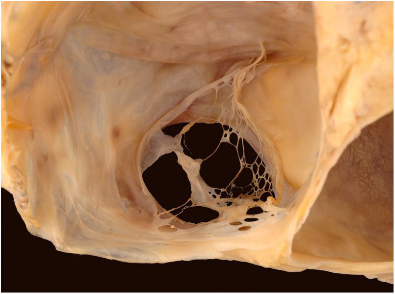 Figure 2.6, Chiari network. This web-like structure represents a fenestrated remnant of the right venous valves and can be seen at the ostium of the inferior vena cava, the coronary sinus, or both.