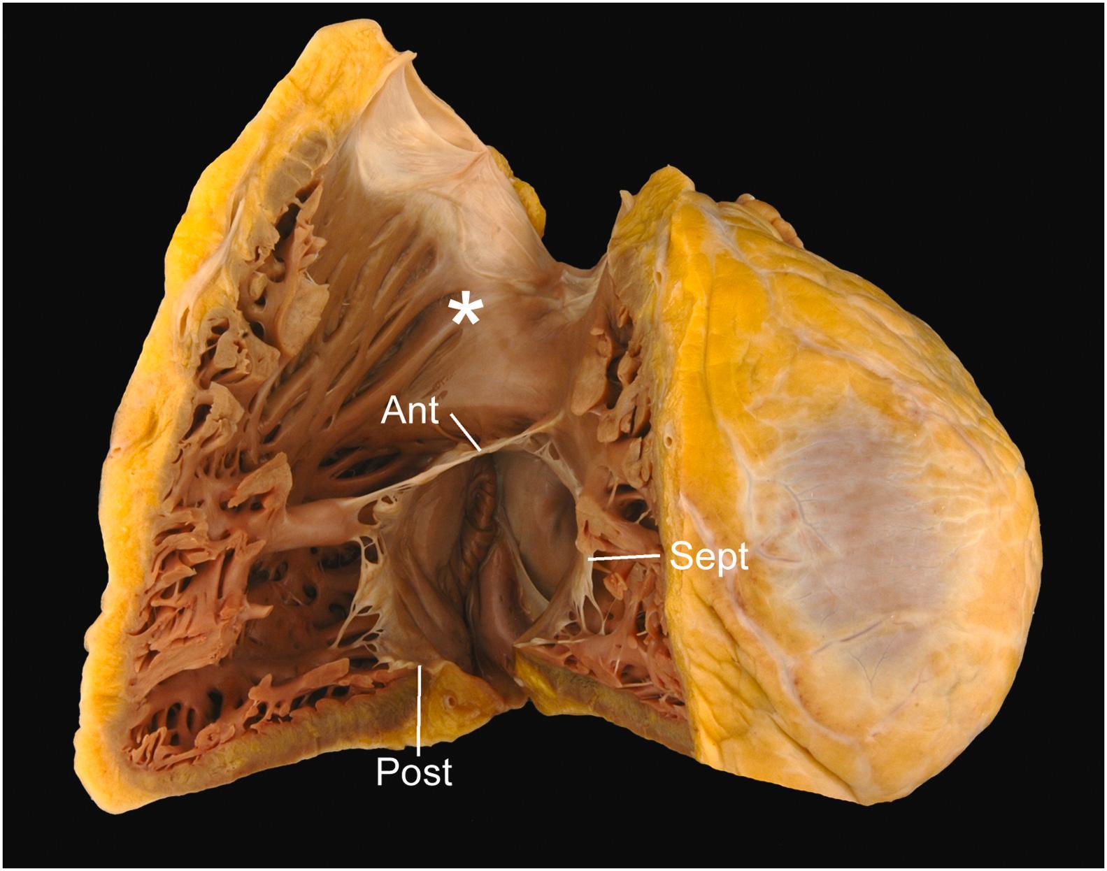 Figure 2.7, Internal anatomy of the right ventricle. The right ventricle, opened along the inflow and outflow portions exhibits the three tricuspid valve leaflets ( Ant , anterior tricuspid valve leaflet; Post , posterior tricuspid valve leaflet; Sept , septal tricuspid valve leaflet). The course apical trabeculations, septal cordal attachments, and the muscular outflow tract (asterisk) serve as morphologic differentiators from the left ventricle.