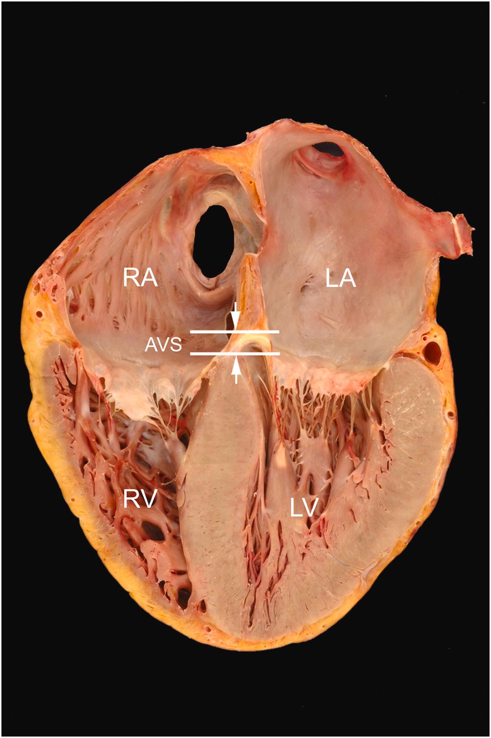 Figure 2.8, Four-chamber view of the heart. In this tomographic plane, all four cardiac chambers can be visualized. Additionally, the more apical position of the tricuspid valve annulus (when compared to the mitral annulus) can be appreciated. The septum between the annuli is called the atrioventricular septum (AVS) that separates right atrium (RA) from left ventricle (LV). LA , left atrium; RV , right ventricle.