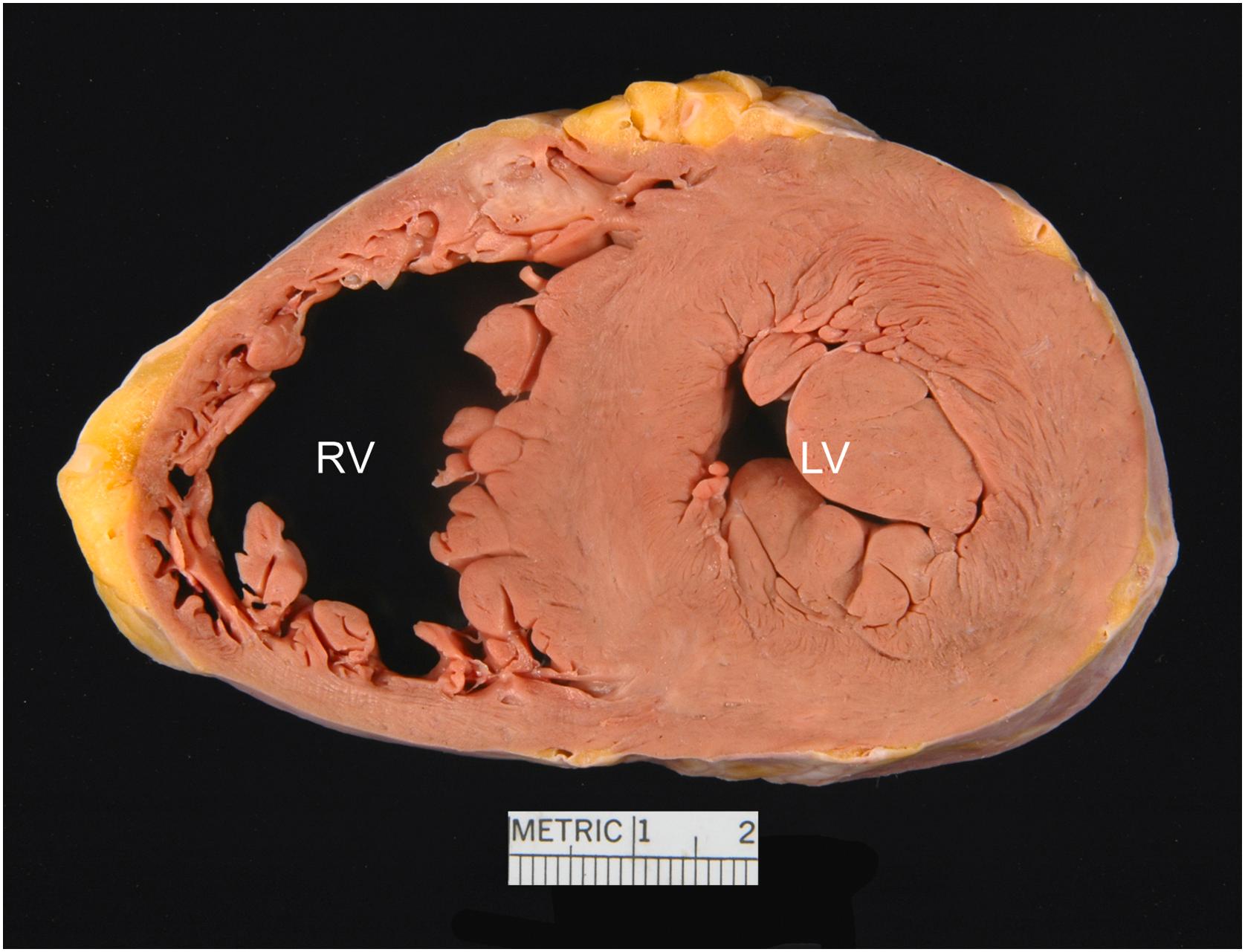 Figure 2.9, Short-axis view of the heart. The circular geometry of the left ventricle (LV) can be seen as well as the crescent-shaped right ventricle (RV). Imaginary lines drawn tangential to the anterior and inferior surfaces of the short-axis will form an acute angle on the right side (acute margin) and an obtuse angle on the left side (obtuse margin).