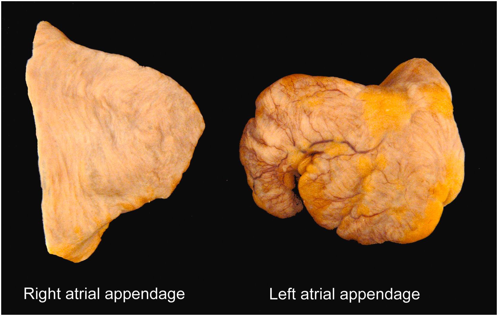 Figure 2.10, External anatomy of the atrial appendages. The right atrial appendage is pyramidal with a broad base. The left atrial appendage has a more variable morphology, but is often vermiform or finger-like in morphology with a more narrow base.