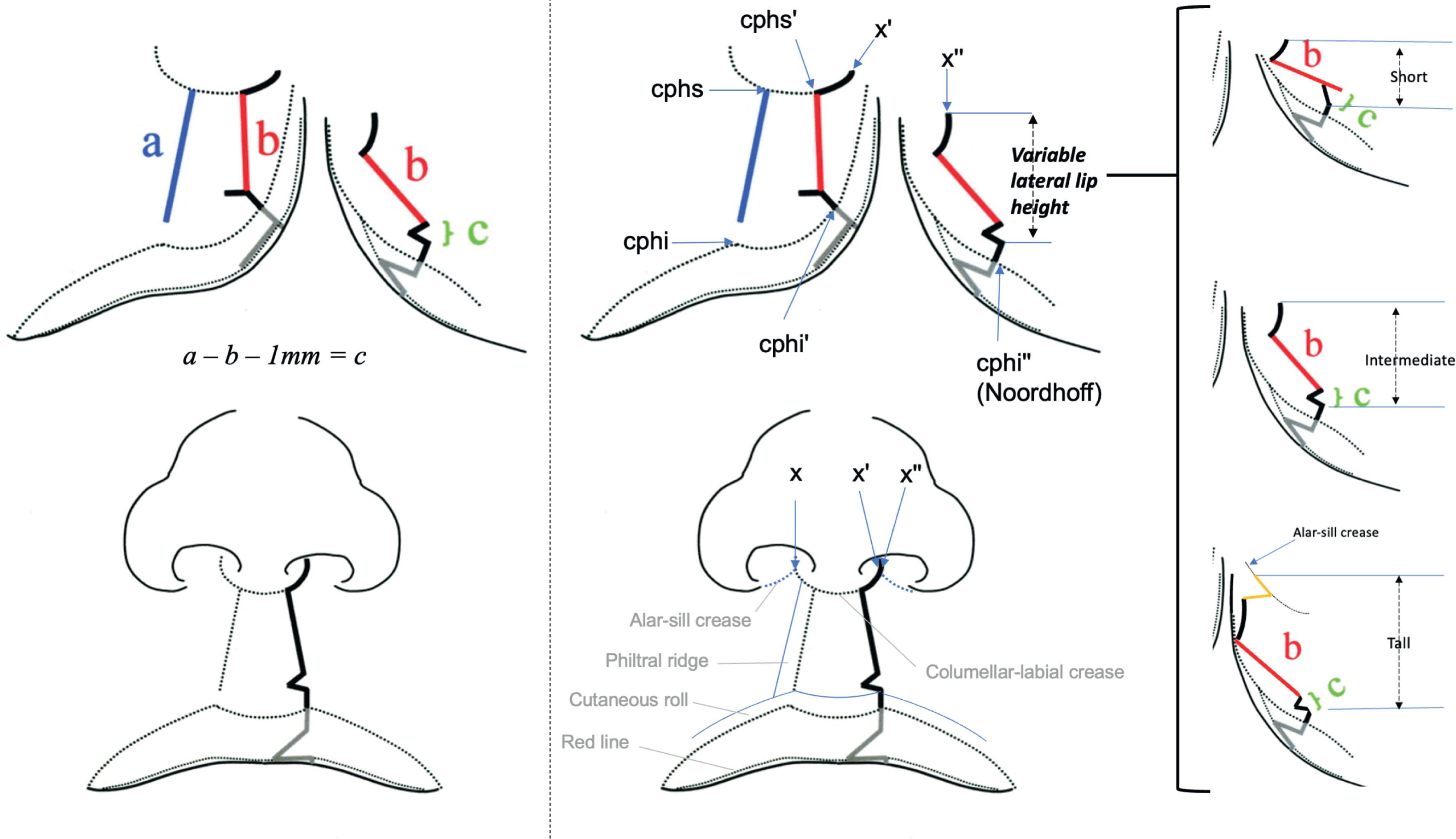 Figure 19.4.2, Anatomic subunit approximation for unilateral cleft lip repair: Original figure (left) with further details (right), including variations in lateral lip design. For nomenclature, see Table 19.4.1 .