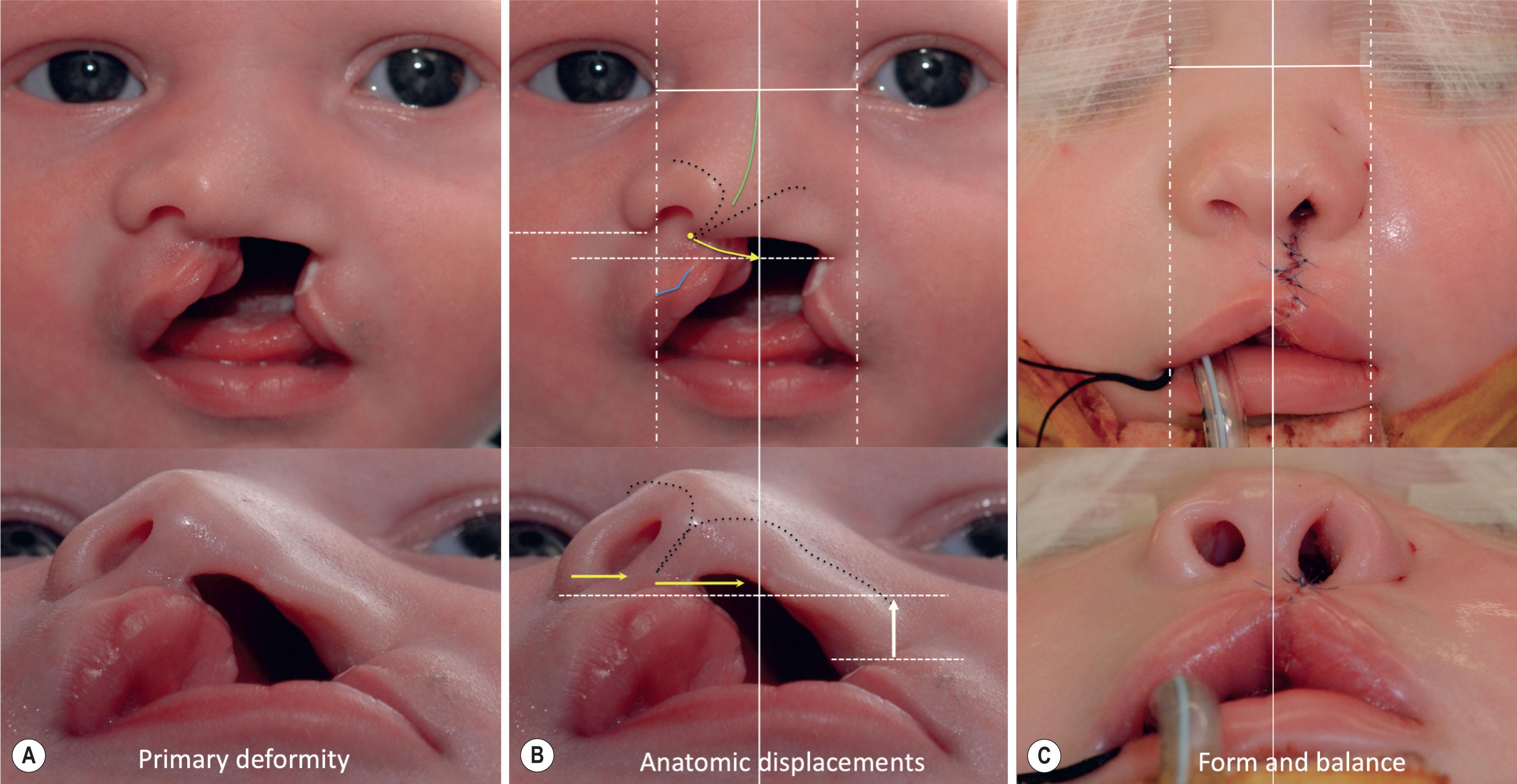 Figure 19.4.3, Optical illusions and surgical goals: (A) The primary deformity appears as if the cleft alar base is displaced laterally, resulting in collapse of the alar dome. Correction would seem to involve medial advancement of the cleft alar base. (B) With reference lines to guide our perceptions, it is actually the outward, upward, and forward deviation of columella and non-cleft alar base, combined with the retroposition of cleft alar base, that result in a twisting collapse of the nose. (C) Correction involves downward rotation of the columella and non-cleft alar base and anterior advancement of the cleft alar base (with no alteration in medial-lateral position).