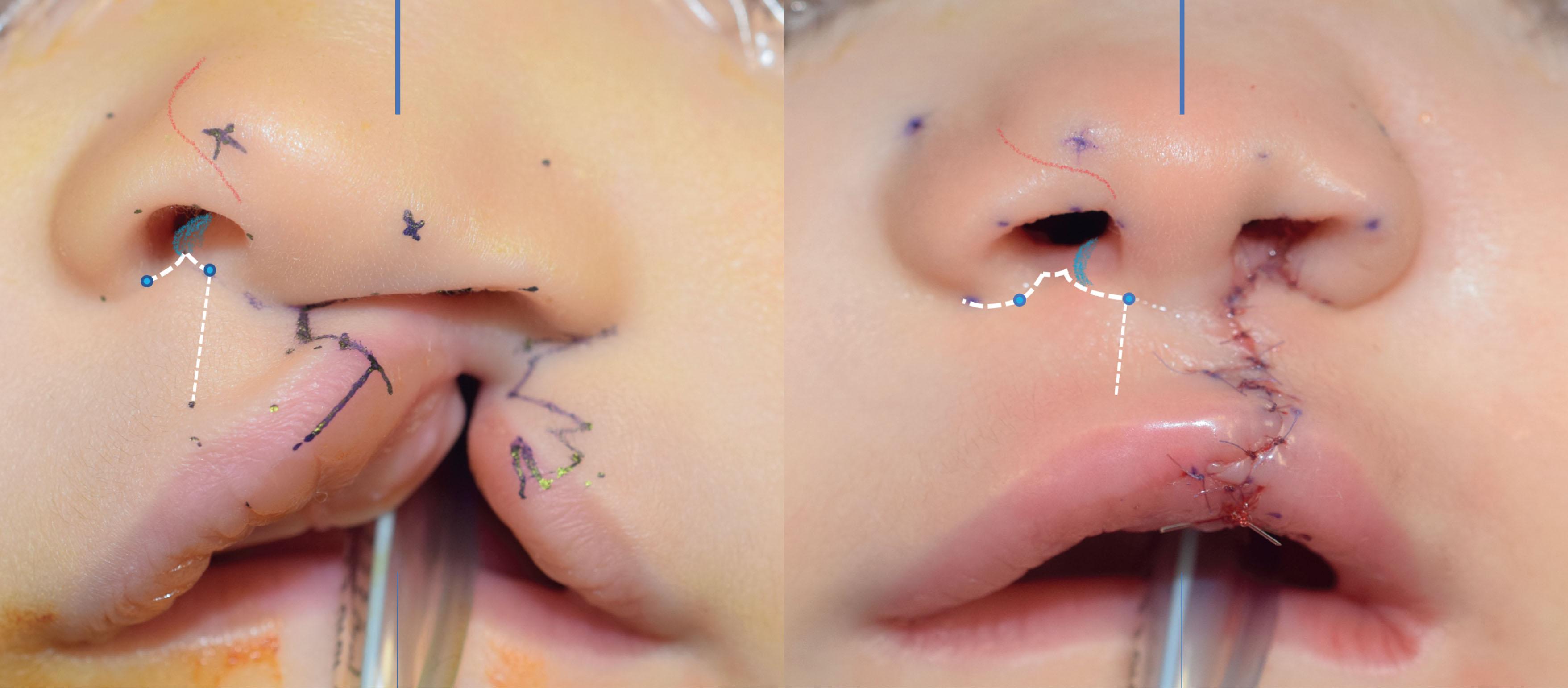 Figure 19.4.4, The non-cleft side is not normal and not static: Uncoupled premaxillary growth results in the non-cleft side being squished. Constriction of the nostril pinches the lateral crura alar ring and makes the hemi-tip prominent and “boxy”. The opposing cleft-side and non-cleft-side alterations are reversed with appropriate repair. The non-cleft-side nasal sill (thick white line) widens, philtral column (thin white line) shortens, medial footplate (blue shading) flattens, and hemi-nasal tip (red mark) softens.