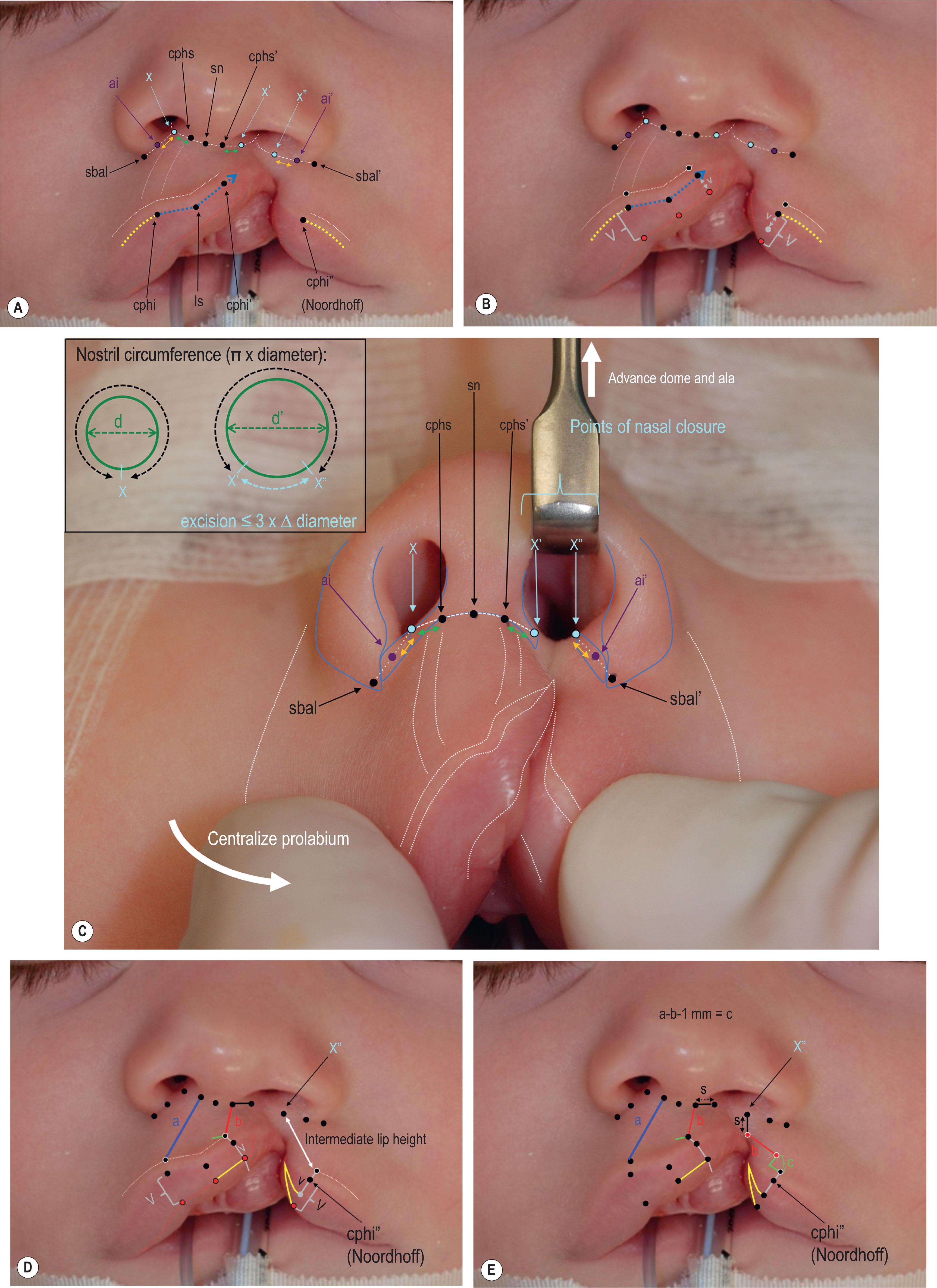 Figure 19.4.6, (A) Standard anthropometric landmarks. X is defined on the non-cleft side at the intersection of columellar–sill crease and alar–sill creases. The points of nasal closure, X′ and X′′ on the cleft side are defined along the same creases, using the other landmarks to define their location (green and orange arrows). Cupid’s bow peaks are defined at the junction of the straight (blue) and convex (yellow) part of the peak. This corresponds to the medial border of the philtral column (white line). (B) Corresponding labial landmarks are placed above the cutaneous roll (black dot with white outline) and along the vermilion–mucosal junction (red dot with black outline). The deficient medial Figure 19.4.6, cont’d lip vermilion height is transposed to the vermilion below Noordhoff point to define the base of the vermilion flap. (C) Nasal base landmarks should be symmetric in position and configuration when the deformity is manually corrected. The points of nasal closure can then be confirmed. The excision between those points can be verified with the nasal floor is intact by measuring relative differences in nostril size. (D) The lateral lip design needs to span or fit into the height between the lateral point of nasal closure and the landmark above the cutaneous roll at Noordhoff. (E) Lateral lip design. (F) The actual repair for complete cleft with band. For nomenclature, see Table 19.4.1 .