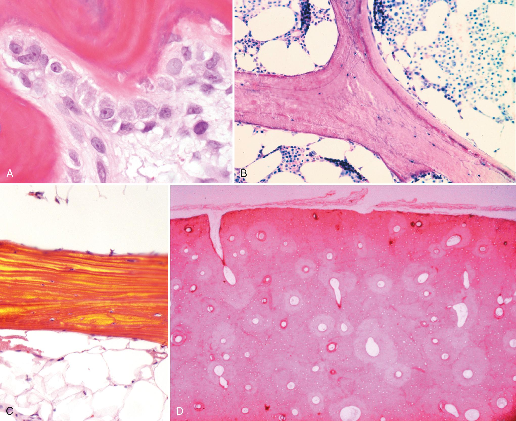 FIG 1.1, (A) Osteoblasts. Plump, cytoplasm-rich osteoblasts actively making osteoid, the type I collagen that in the normal sequence of events becomes the fibrous matrix of mineralized bone. (B) Normal cancellous (trabecular, spongy) bone bathed in normal hematopoietic marrow. Bone surfaces are smooth. Osteoid deposition (light pink surface) is interfaced with mature bone by the basophilic mineralization front. (C) Normal cancellous bone. With the use of polarized light microscopy, the organized lamellar or pleated deposition of the collagen matrix of mineralized bone is appreciated. (D) Cross-section of cortical bone showing numerous haversian systems of varying age. The cortical bone is surrounded on its surface by periosteum. The cortical bone itself is composed of haversian bone systems, which represent interwoven longitudinal, circumferential, and concentric bone-forming units (osteons) characterized by central haversian canals of various size and shape. Remodeling is ongoing throughout life; most of it occurs in an axial direction down the shaft.