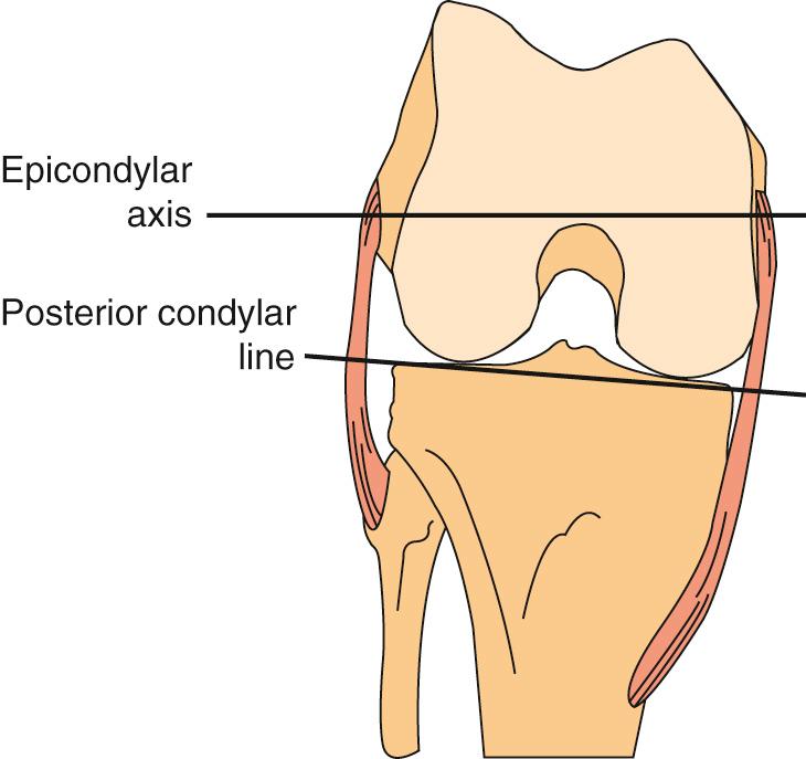 FIG 1.11, The epicondylar axis, which connects the prominence of the lateral epicondyle and the sulcus of the medial epicondyle, is externally rotated relative to the posterior condylar line.