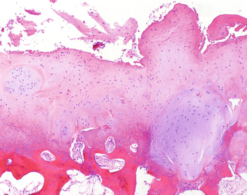 FIG 1.14, Degenerative or Chondromalacic Articular Cartilage