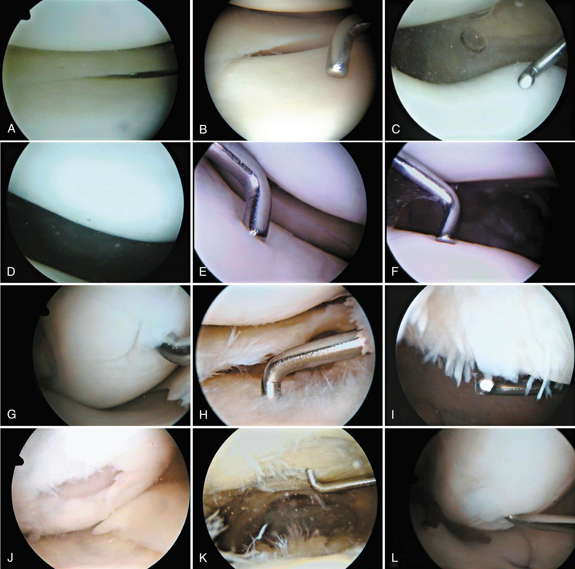 FIG 1.15, Arthroscopic Views of Articular Cartilage