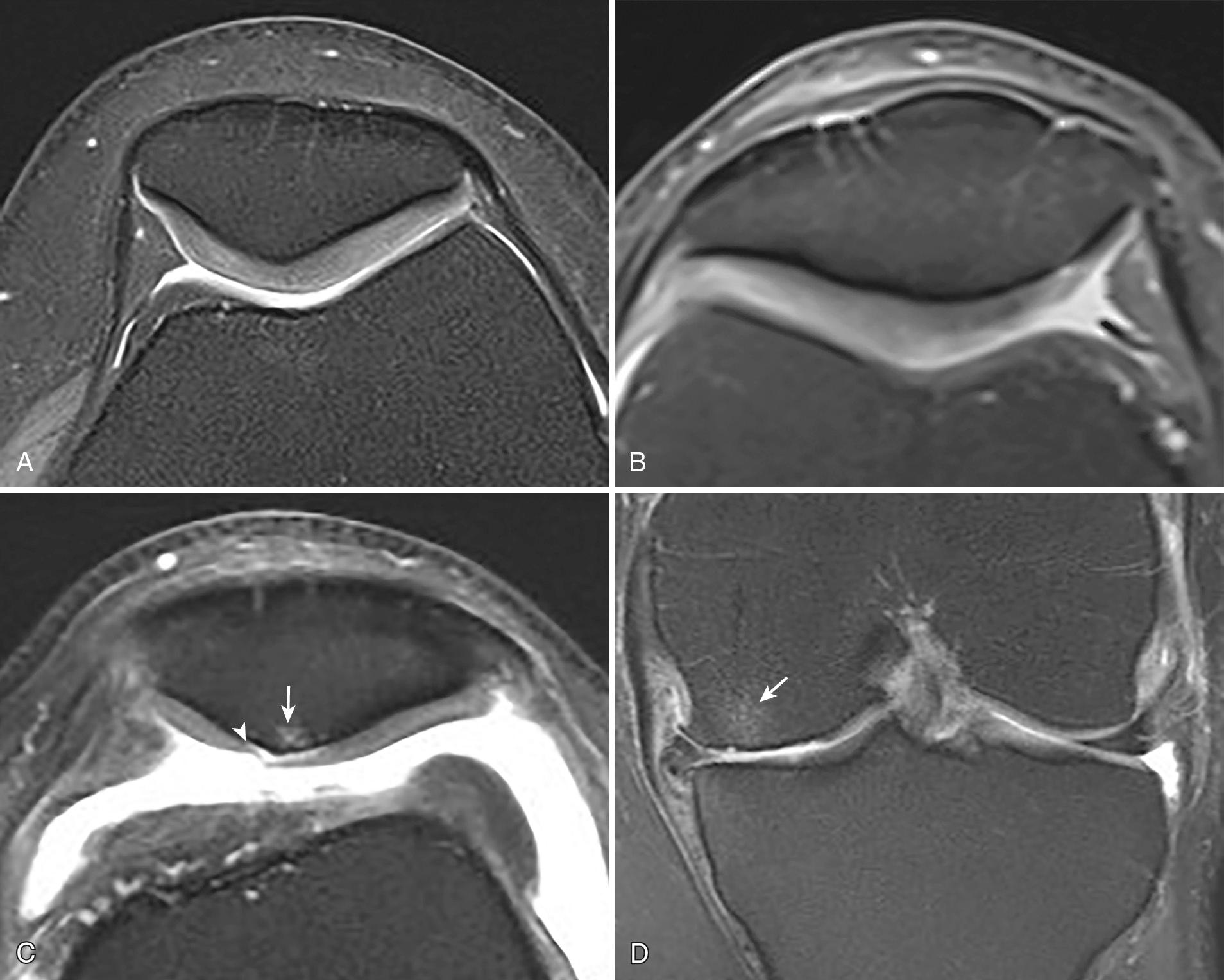 FIG 1.16, Normal and Abnormal Cartilage as Seen on Fat-Suppressed Proton Density (PD) Imaging