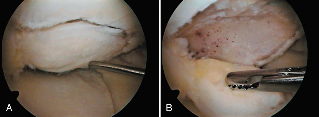 FIG 1.17, Arthroscopic View of Osteochondritis of the Femoral Condyle