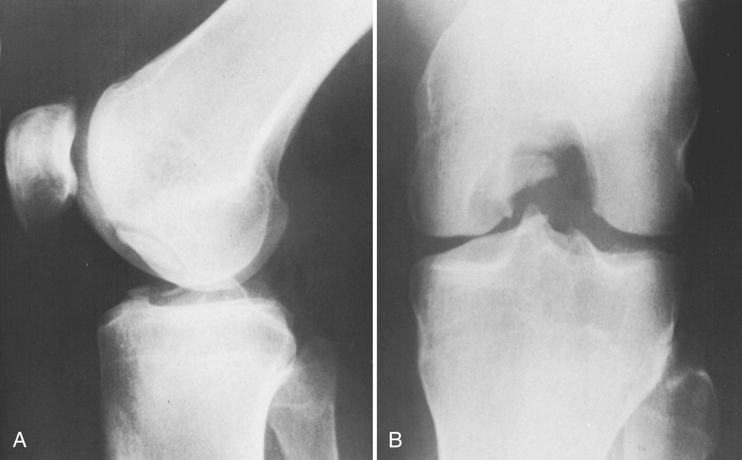 FIG 1.18, Radiographs of Osteochondritis Dissecans