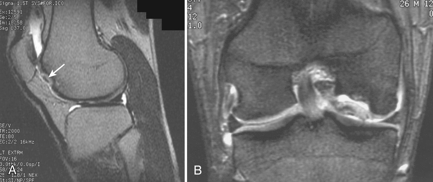 FIG 1.19, (A) Sagittal MRI demonstrating a well-demarcated osteochondral lesion (arrow) in the anterior aspect of the lateral femoral condyle. (B) Coronal MRI showing high-signal fluid about a loose osteochondral fragment of the medial femoral condyle.