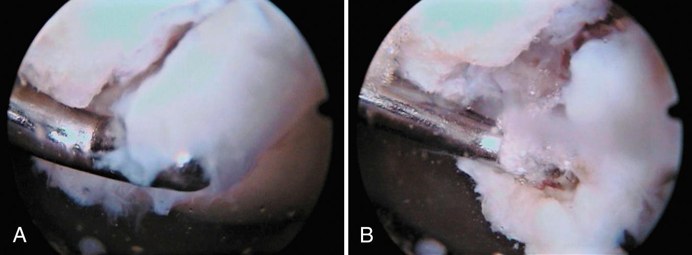 FIG 1.20, Arthroscopic Views of Osteonecrosis of the Femoral Condyle