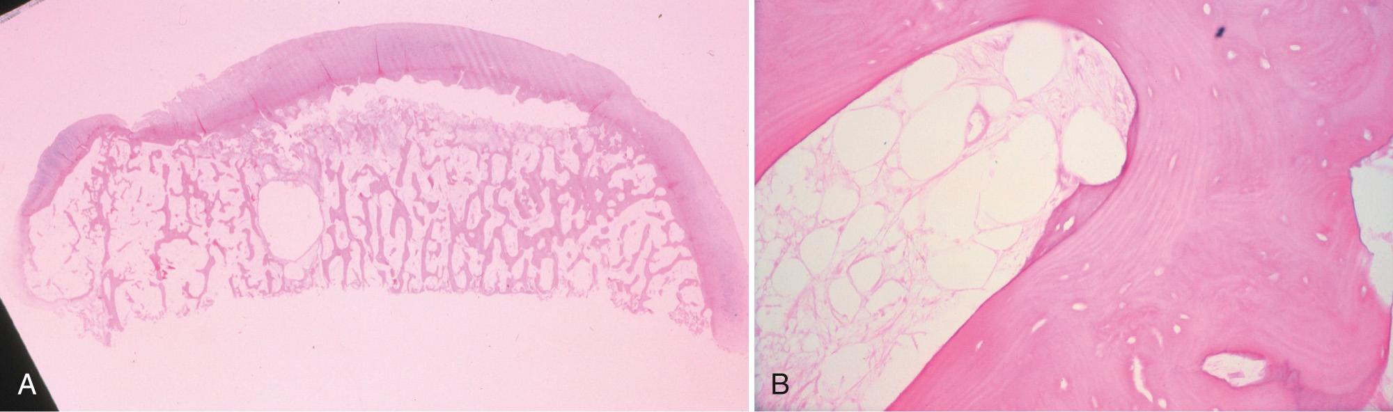 FIG 1.21, (A) Osteonecrosis. A subchondral lucent zone is surrounded by intact articular cartilage and a thin plate of subchondral bone superficially with collapsed necrotic bone and granulation tissue inferiorly. (B) Osteonecrosis (high power). Dead bone is characterized by marrow fat necrosis imparting a foggy, acellular appearance and bone devoid of osteocytes (empty lacunar spaces) and bone-lining cells.