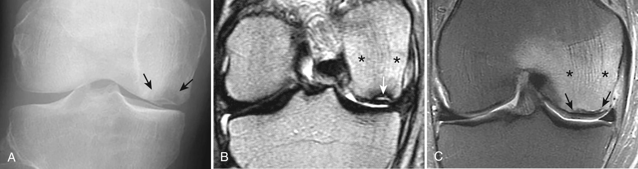 FIG 1.22, Insufficiency Fracture of the Medial Femoral Condyle With Articular Collapse (Previously Termed Spontaneous Osteonecrosis )