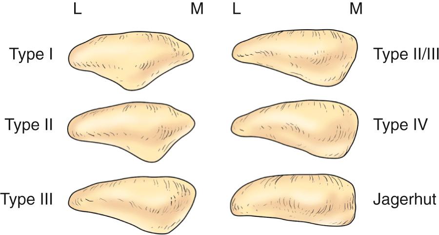 FIG 1.6, Wiberg and Baumgartl's Patella Types 12 133