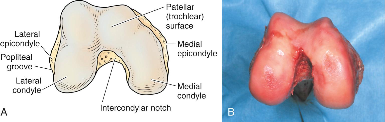 FIG 1.9, (A) Bony architecture of the distal femur. (B) Anatomic specimen of the distal femur. The femoral trochlea separates the lateral and medial femoral condyles. The deepest point lies slightly offset to the lateral side. The anterior aspect of the lateral condyle is more prominent than the medial side.