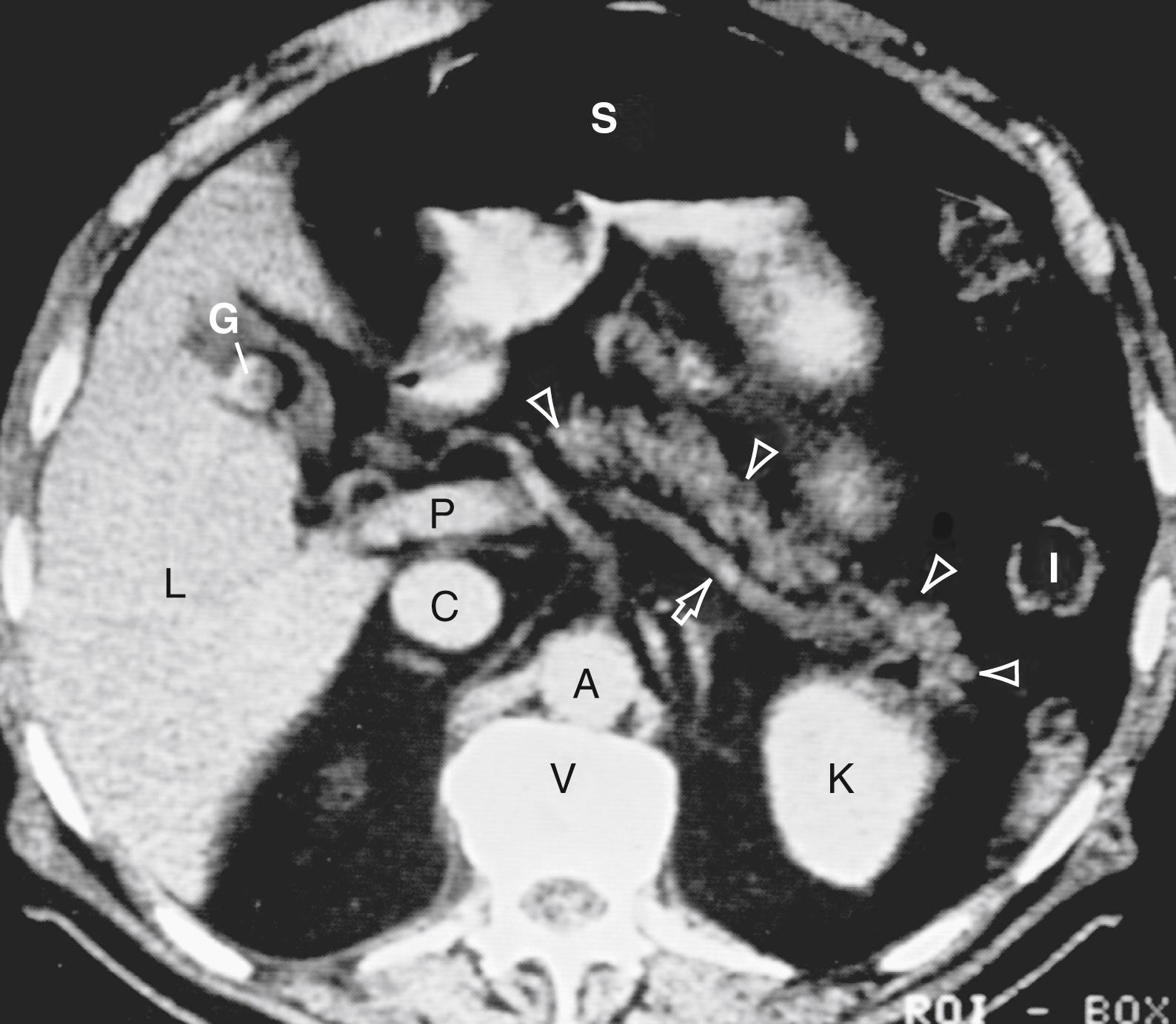 Fig. 55.2, CT showing the normal anatomic relation of the pancreas with other intra-abdominal structures. The borders of the pancreas are indicated by arrowheads . The splenic vein is indicated by an arrow . A , Aorta; C , vena cava; G , incidental gallstone; I , small intestine; K , left kidney; L , liver; P , portal vein; S , stomach; V , vertebra.