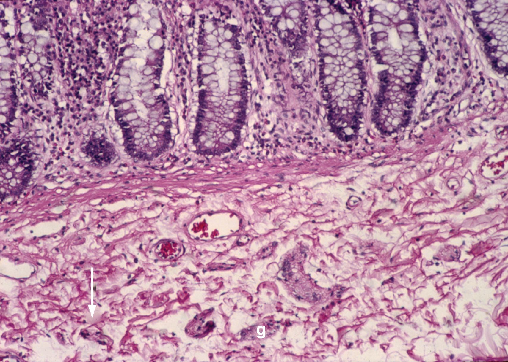 Fig. 98.11, Photomicrograph showing a normal submucosal plexus of the colon. Ganglia ( g ) are identified by their oval structure, and nerve trunks are thin ( arrow ). (H&E, ×150.)