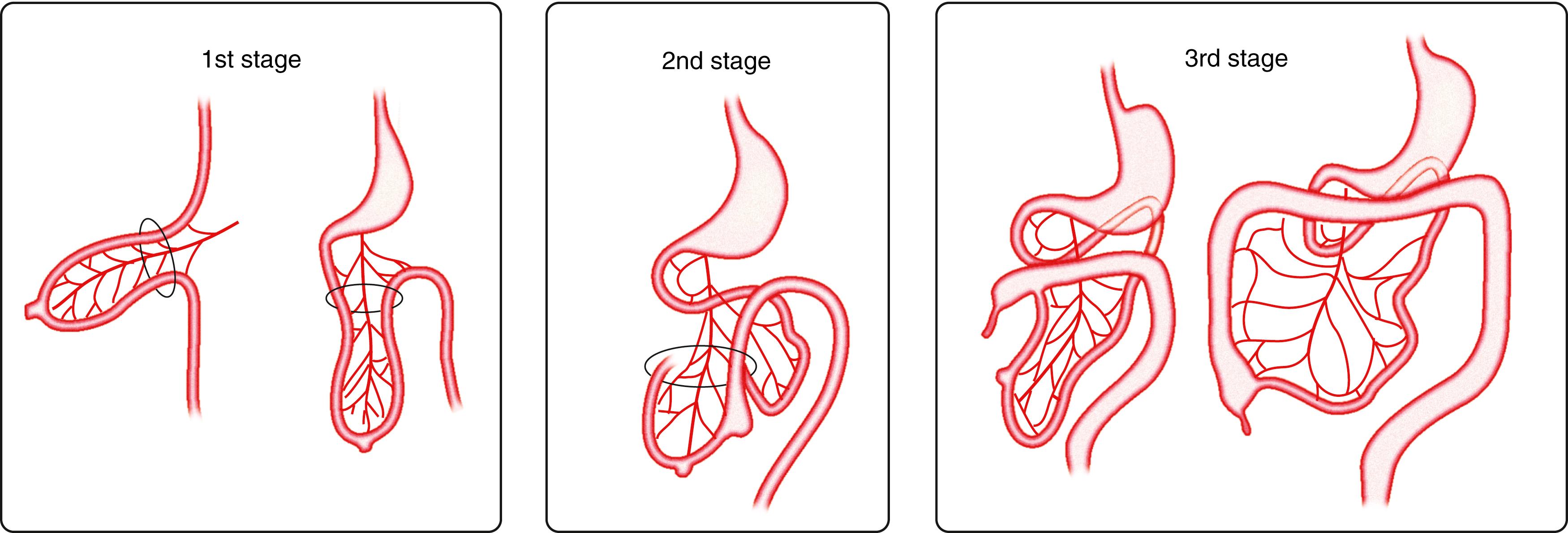 Fig. 98.14, The 3 stages of normal intestinal rotation (see text for details). (From Gosche JR, Touloukian RJ. Congenital anomalies of the midgut. In: Wyllie R, Hyams JS, editors. Pediatric gastrointestinal disease. Pathophysiology, diagnosis, management. 2nd ed. Philadelphia: WB Saunders; 1999.)