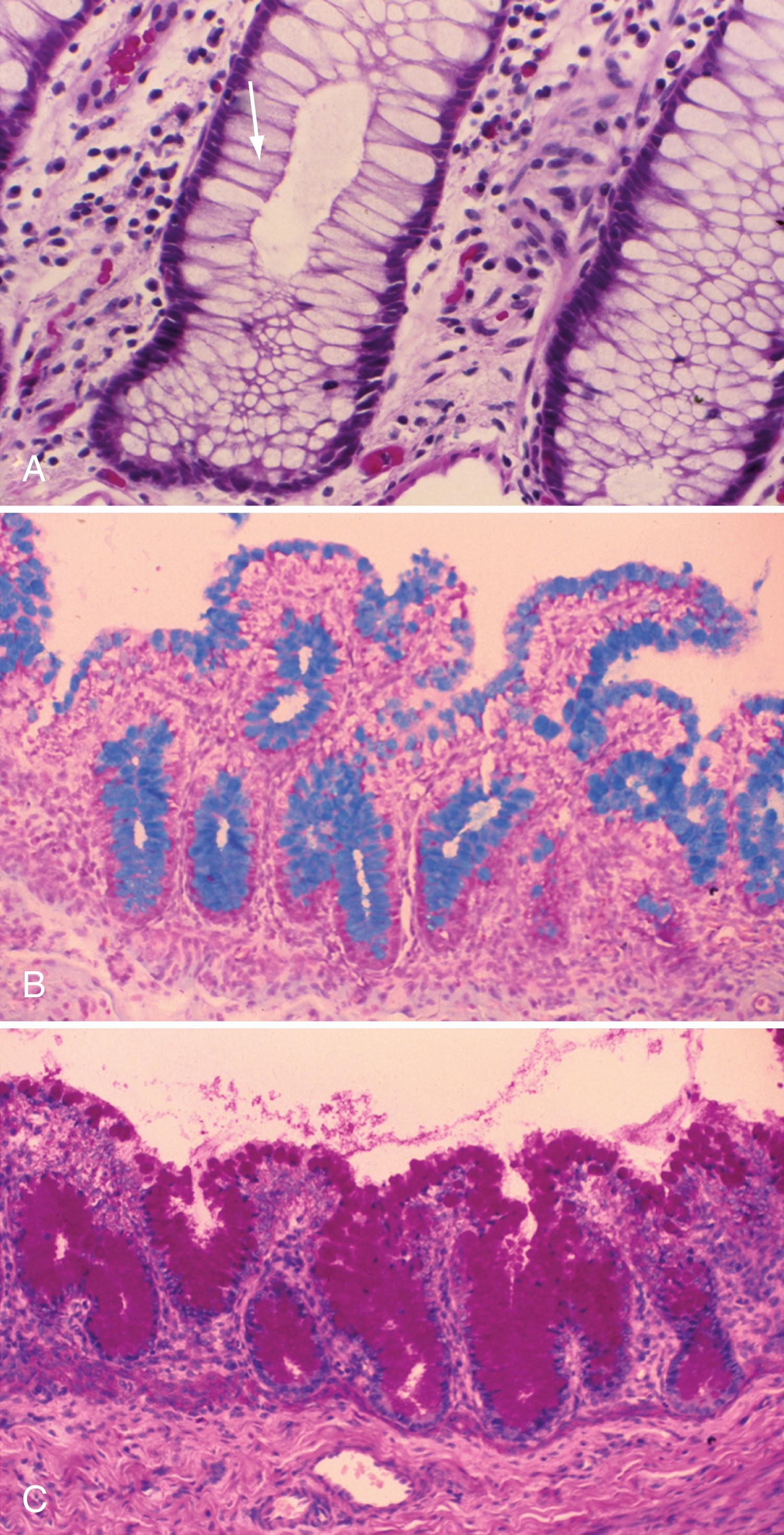 Fig. 98.4, Photomicrographs of large and small intestine demonstrating goblet cells. A, Clear, empty-looking cytoplasm ( arrow ) and basal nuclei are seen with use of H&E, ×250. B, Metachromatic staining of the cytoplasm results with use of the alcian blue stain, ×50. C, The cells demonstrate red staining with use of periodic acid–Schiff stain, ×150.