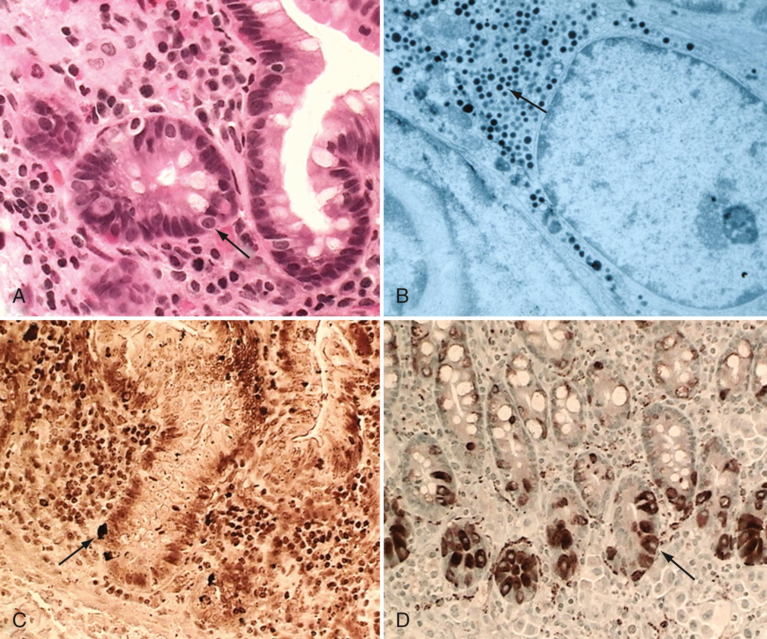 Fig. 98.6, Microscopic characteristics of neuroendocrine cells of the small intestine. A, Features include clear cytoplasm and a round nucleus ( arrow ). (H&E, ×250.) B, Neurosecretory granules are seen as electron-dense, round black bodies ( arrow ) on electron microscopic examination, ×20,000. C, Granules in neuroendocrine cells are stained black with the Grimelius stain ( arrow ), ×150. D, Cells stained with synaptophysin have brown cytoplasm ( arrow ), ×250.