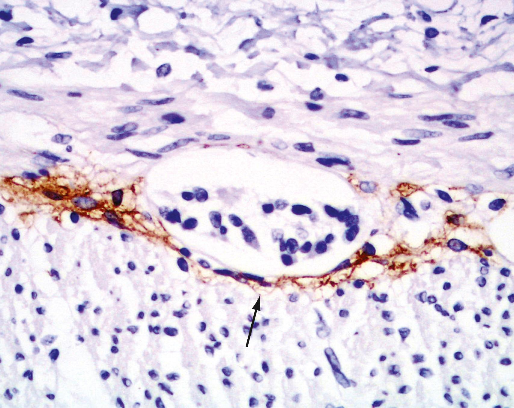 Fig. 98.7, Photomicrograph showing interstitial cells of Cajal in the small intestine. Brown-staining, elongated cells are evident around the myenteric plexus ( arrow ). (CD117 immunostain, ×250.)