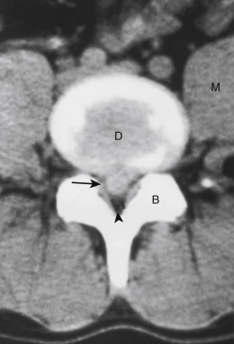 FIGURE 15-13, Herniated disk on unenhanced computed tomography reveals a disk at L2-3. Huge central herniated disk (arrow) is squashing the thecal sac. Herniated disk and the parent disk (D) have the same density. Note the array of densities from disk (D), bone (B), muscle (M), and posterior epidural fat (arrowhead).