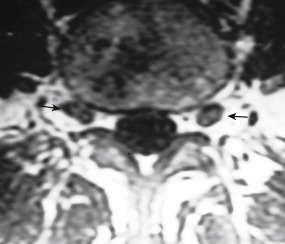 FIGURE 15-2, These ganglia of dorsal root supply sensation to the foot. Axial T1-weighted imaging demonstrates normal appearance of the dorsal root ganglia (arrows). Do not mistake this for a foraminal disk herniation. Note normal appearance of surrounding hyperintense fat within the foramen.