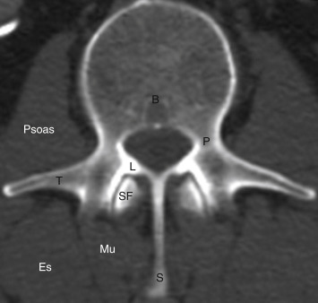 FIGURE 15-3, Lumbar vertebral anatomy shown by multiplanar computed tomography (CT). This CT of a lumbar vertebral serves as a model for a generalized vertebra. Pedicle (P), lamina (L), transverse process (T), basivertebral venous plexus (B), superior facet from vertebral below (SF) and spinous process (S) are labeled. Psoas muscle, multifidus (Mu), and erector spinae (Es) are labelled.