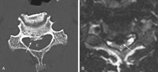 FIGURE 15-9, Cervical spine osteophyte. Computed tomography (CT) (A) and T2-weighted imaging (B) show osteophyte from posterior body cervical spine (arrows) compressing the spinal cord (C), which is inferred on the CT but directly visualized in cross-section on the magnetic resonance study.
