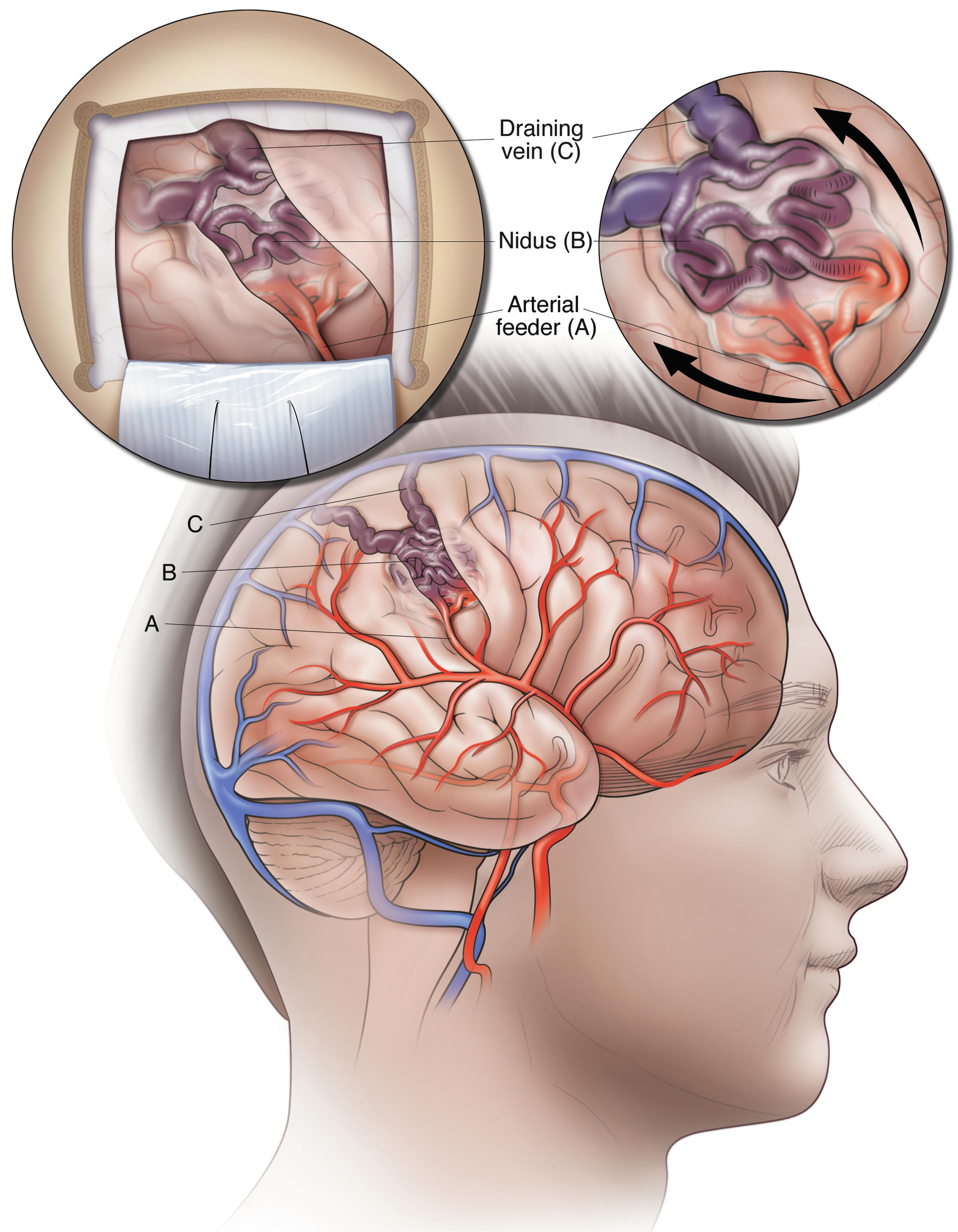 Fig. 1.1, Artistic illustration of an iAVM showing the surgeon’s initial view ( inset on left ) and a closer view ( inset on right ) with arrows indicating the direction of blood flow. Intracranial AVMs are focal abnormal masses of dilated arteries and veins that are characterized by a direct connection between the arterial and venous systems and appear as a tangle of vessels pulsating and swirling in the sulci and gyri of the brain. A, the arterial feeding vessel; B, the AVM nidus; C, a draining vein.