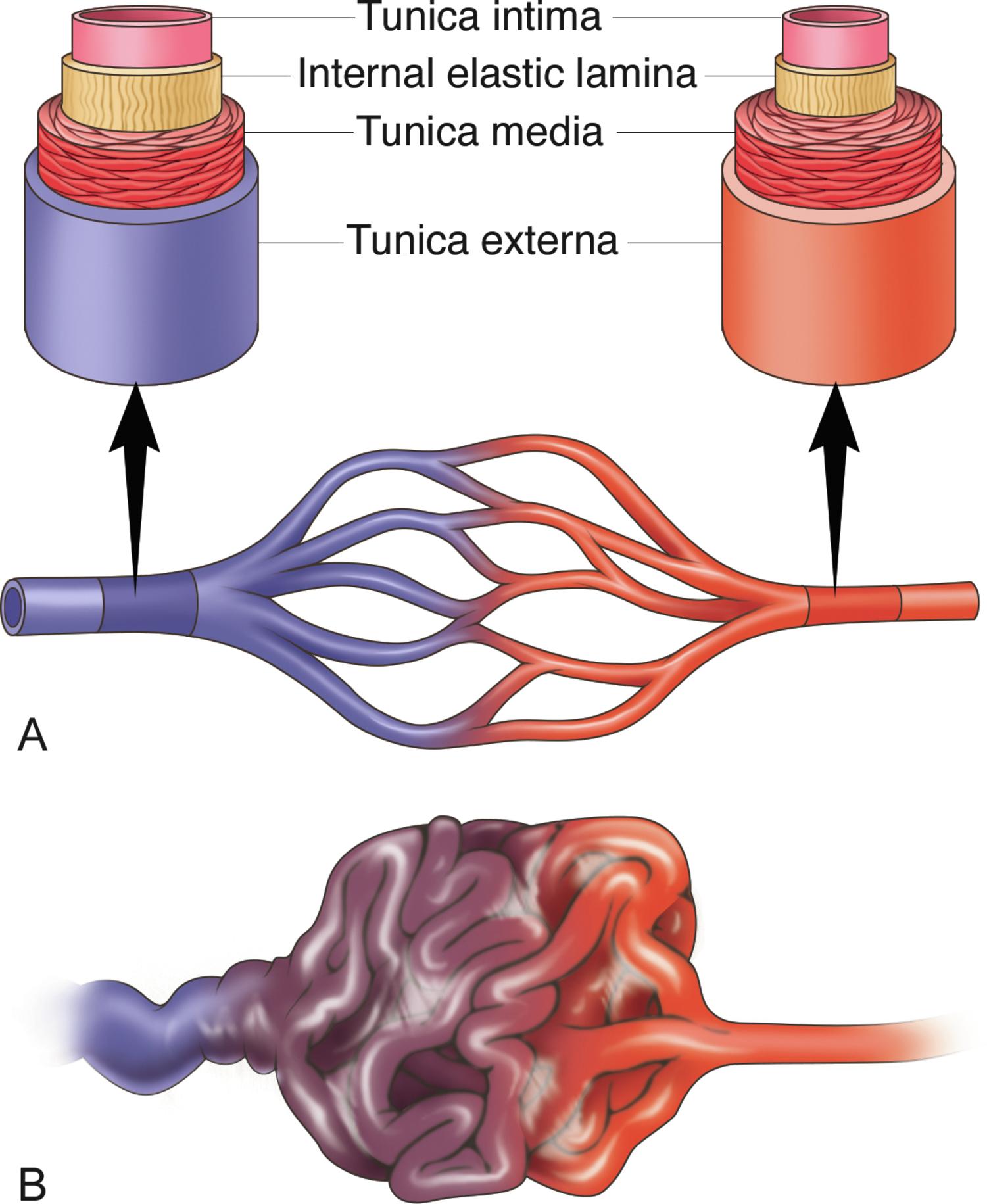 Fig. 1.2, Schematic illustration showing the difference between normal vascular architecture, with a capillary bed ( A ), and an AVM ( B ). Capillary beds are the primary sites of oxygen and nutrient exchange and are composed of a dense network of intercommunicating vessels that consist of specialized endothelial cells without smooth muscle cells. The walls of cerebral arteries and arterioles consist of three concentric layers. The innermost layer, the tunic intima, consists of a single layer of endothelial cells and the internal elastic lamina. The middle layer, the tunica media, contains mainly smooth muscle cells with some elastin and collagen fibers. The outermost layer, the tunica externa, is composed mainly of collagen fibers, fibroblasts, and associated cells, including perivascular nerves. The walls of cerebral veins are much thinner than arterial walls, lacking smooth muscle. In contrast to peripheral veins, cerebral veins do not contain valves. In an iAVM, the loss of normal vascular organization at the subarteriolar level and the lack of a capillary bed result in abnormal arteriovenous shunting.