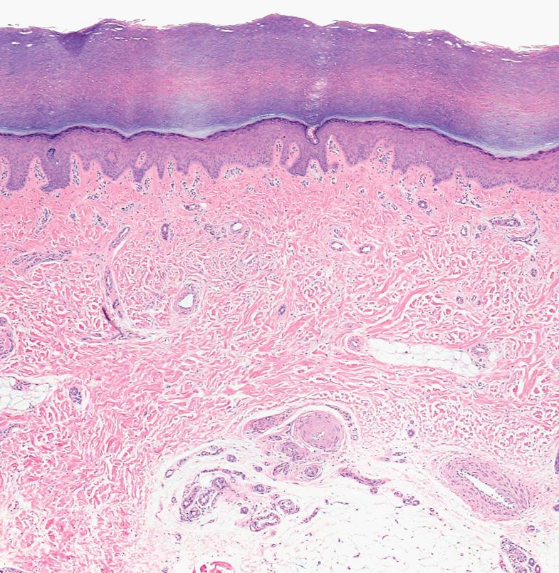 Fig. 1.3, Histopathologic features of normal plantar skin.