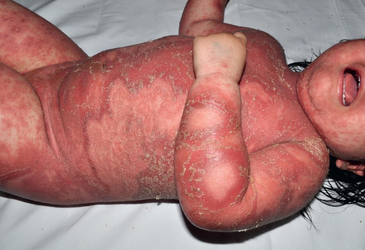 Fig. 1.6, Severe pustular psoriasis in an infant.