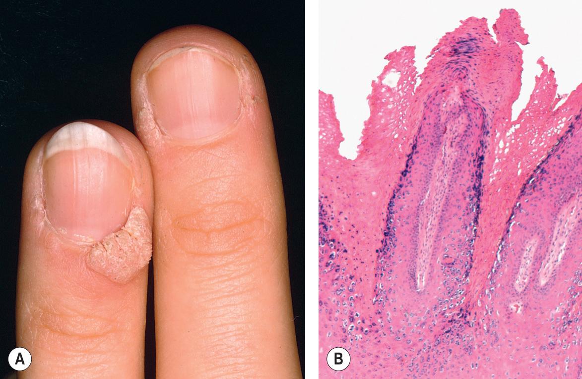 Fig. 1.7, Verrucae vulgares.