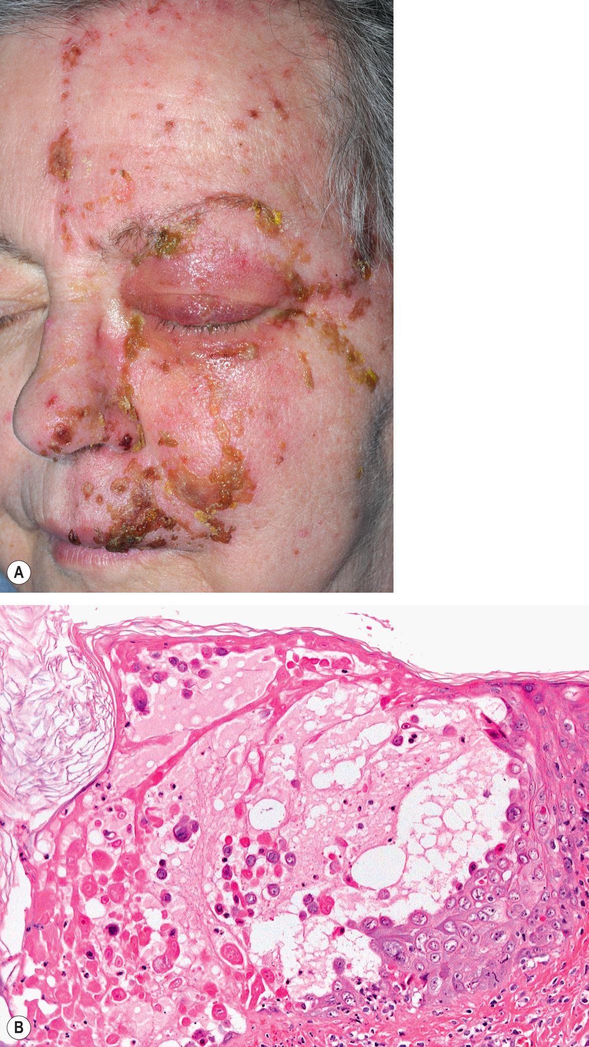 Fig. 1.8, Herpes zoster involving the ophthalmic (V1) and maxillary (V2) branches of the trigeminal nerve.