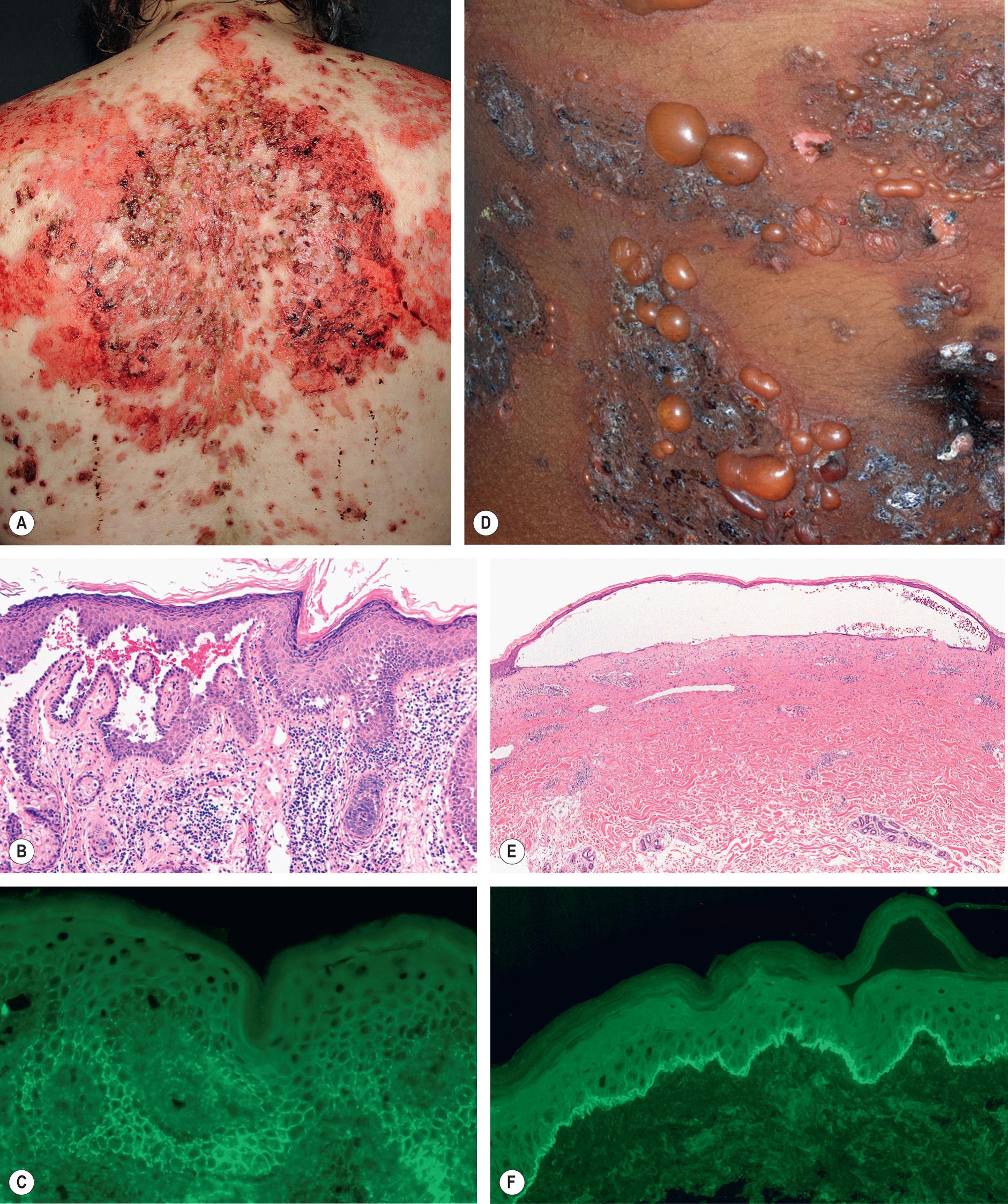 Fig. 1.9, Pemphigus vulgaris versus bullous pemphigoid.