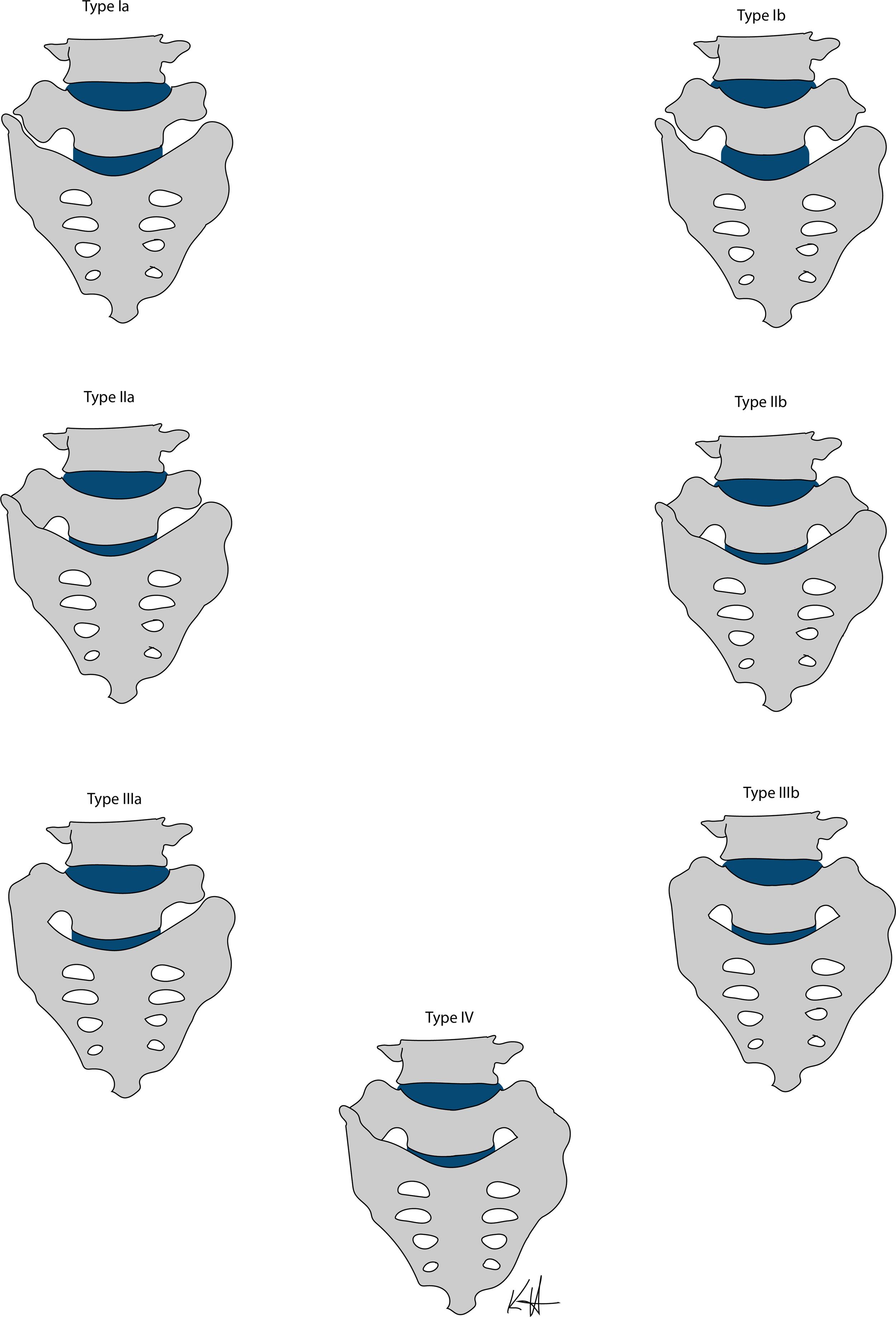 Fig. 1.1, Castellvi classification system: Ia, Ib, IIa, IIb, IIIa, IIIb, IV.